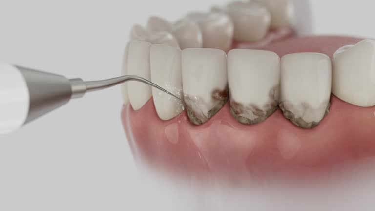 Reliable Tooth Extraction contractor in LaCoste, TX by Smile Center Dentistry